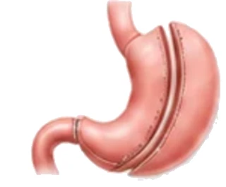 Bariatric surgery